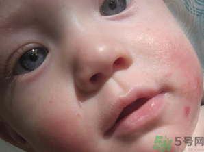 寶寶長(zhǎng)奶蘚怎么回事？寶寶長(zhǎng)奶蘚怎么辦？