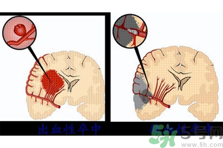腦出血的發(fā)病因素是什么？腦出血的并發(fā)癥有哪些？
