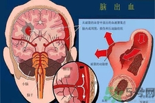 腦出血的發(fā)病因素是什么？腦出血的并發(fā)癥有哪些？