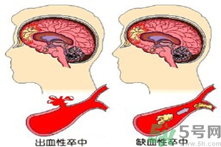 腦出血的治療方法是什么？腦出血可以用哪些藥物治療？