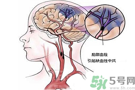 腦出血的治療方法是什么？腦出血可以用哪些藥物治療？