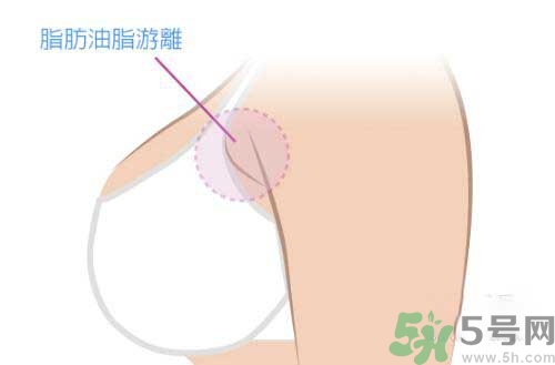 副乳是什么？副乳的危害