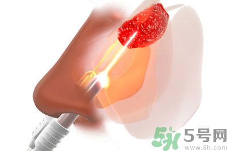 鼻咽癌的日常措施是什么？鼻咽癌注意的飲食有哪些？