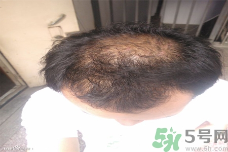 脫發(fā)的措施有什么？脫發(fā)的注意飲食有哪些？