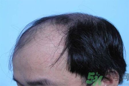 脫發(fā)的措施有什么？脫發(fā)的注意飲食有哪些？