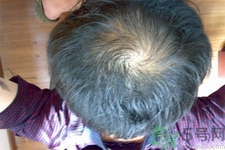 脫發(fā)的高發(fā)人群有哪些？如何預(yù)防脫發(fā)？