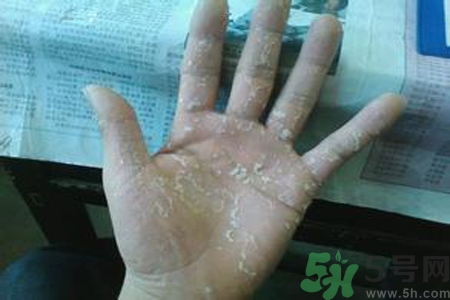 引起手足癬的主要原因？手足癬會引發(fā)什么疾??？