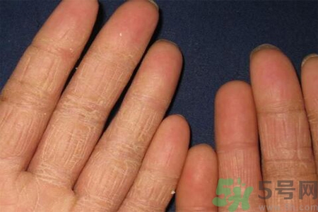 手足癬的治療方法？治療手足癬可以用什么藥？