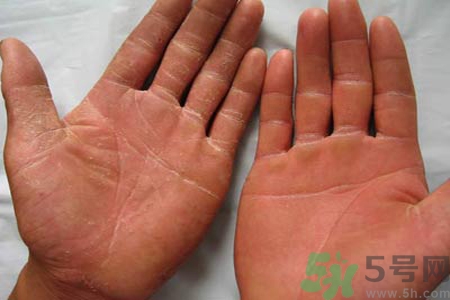 手足癬的治療方法？治療手足癬可以用什么藥？