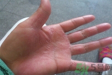 手足癬的易發(fā)人群有哪些？如何預(yù)防手足癬？