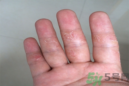 手足癬的易發(fā)人群有哪些？如何預(yù)防手足癬？