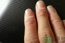 手足癬會傳染嗎？手足癬的傳播途徑有哪些？