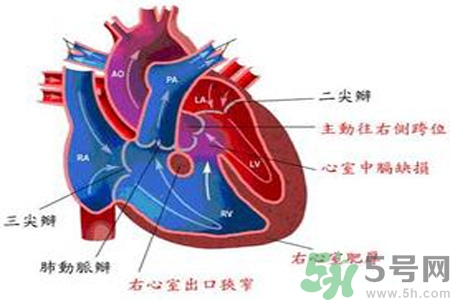 先天性心臟病發(fā)病原因是什么？