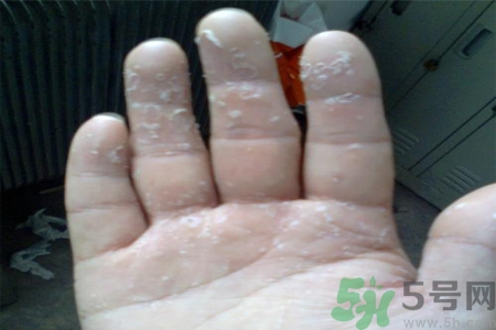 手足癬的易發(fā)人群有哪些？如何預(yù)防手足癬？