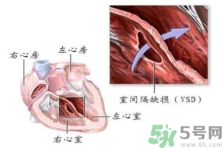 心臟病是怎么形成的？易發(fā)人群有哪些？