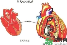 心臟病的癥狀是什么？心臟病的種類有哪些？