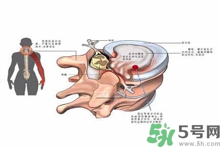 為什么年輕人容易得頸椎??？頸椎病嚴(yán)重的癥狀有哪些？