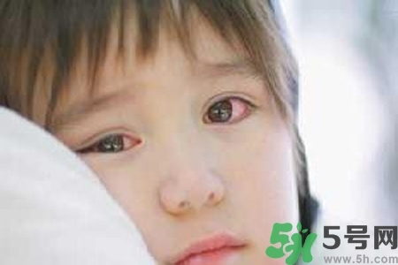 寶寶為什么會感染紅眼?。繉殞毣技t眼病如何治療？