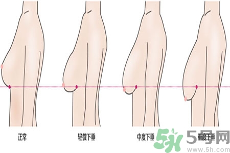 ?女性乳房下垂的原因是什么？女性乳房下垂的分類有哪些？