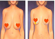 ?女性乳房下垂的原因是什么？女性乳房下垂的分類有哪些？