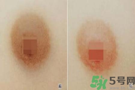 乳頭發(fā)黑怎么辦？怎么樣可以使乳頭變白？