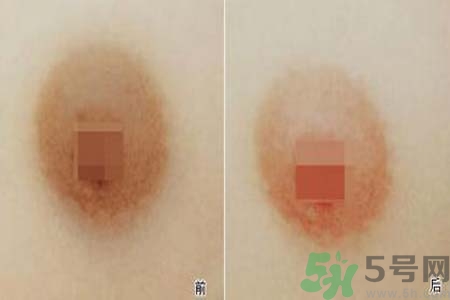乳頭發(fā)黑是怎么回事？乳頭發(fā)黑是什么原因？