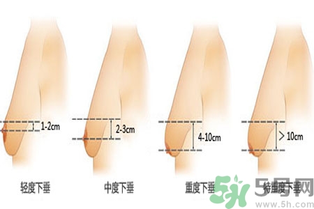 胸部松弛的原因是什么？胸部松弛該怎么辦？