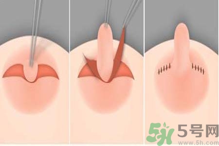 乳頭內(nèi)陷怎么回事？乳頭內(nèi)陷的原因是什么？