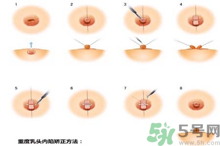 乳頭內(nèi)陷怎么回事？乳頭內(nèi)陷的原因是什么？