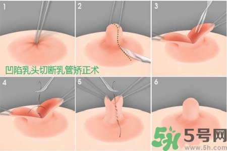 乳頭內(nèi)陷怎么辦？乳頭內(nèi)陷的癥狀有哪些？