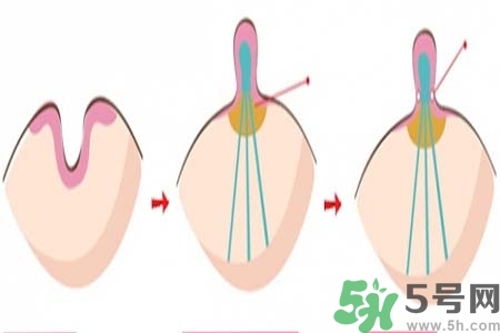 乳頭內(nèi)陷怎么辦？乳頭內(nèi)陷的癥狀有哪些？