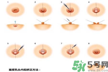 乳頭內(nèi)陷怎么辦？乳頭內(nèi)陷的癥狀有哪些？