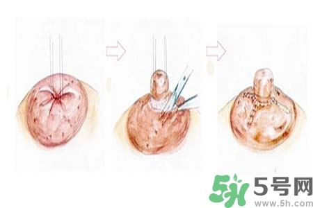 乳頭內(nèi)陷怎么辦？乳頭內(nèi)陷的癥狀有哪些？