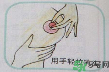 乳頭內(nèi)陷怎么辦？乳頭內(nèi)陷的癥狀有哪些？