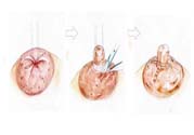 乳頭內(nèi)陷矯正需注意什么？乳頭內(nèi)陷如何預(yù)防？