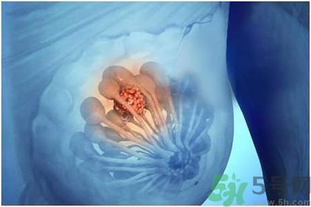 怎樣區(qū)分乳房包塊是良性還是惡性？如何診斷乳房腫塊是惡性還是良性？
