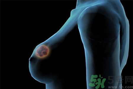 怎樣區(qū)分乳房包塊是良性還是惡性？如何診斷乳房腫塊是惡性還是良性？