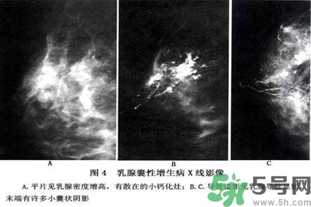 產生乳腺增生鈣化的病因是什么？乳腺增生怎樣治療？
