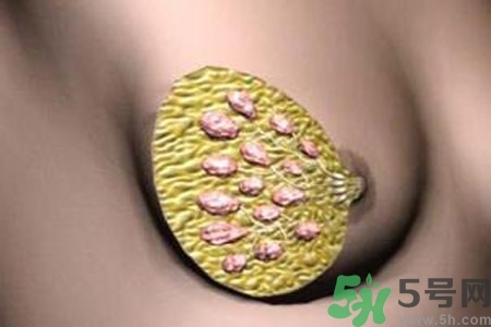 乳腺增生鈣化是什么？乳腺鈣化的癥狀有哪些？