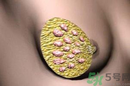 產生乳腺增生鈣化的病因是什么？乳腺增生怎樣治療？