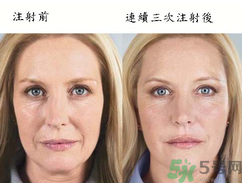 3D液態(tài)拉皮多少錢？3D液態(tài)拉皮后多久見效？