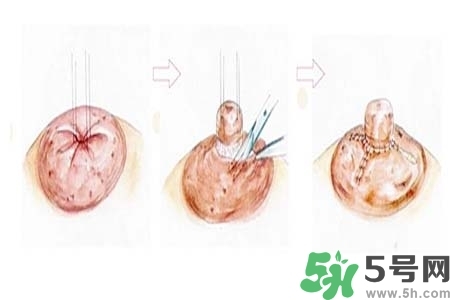 乳頭內(nèi)陷怎么矯正？乳頭內(nèi)陷矯正方法是什么？