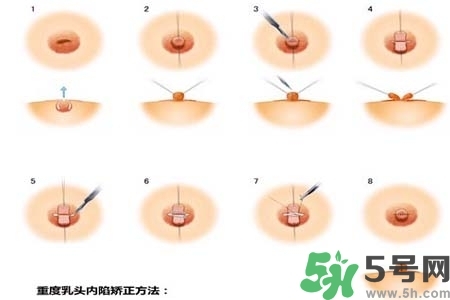 乳頭內(nèi)陷怎么矯正？乳頭內(nèi)陷矯正方法是什么？