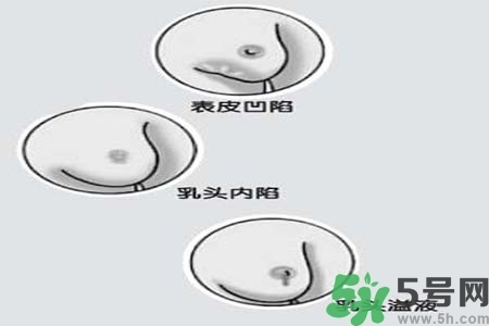 乳頭內(nèi)陷怎么矯正？乳頭內(nèi)陷矯正方法是什么？
