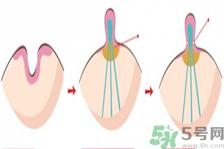 乳頭內(nèi)陷矯正需注意什么？乳頭內(nèi)陷如何預(yù)防？
