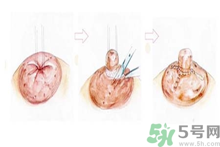 乳頭內(nèi)陷矯正需注意什么？乳頭內(nèi)陷如何預(yù)防？