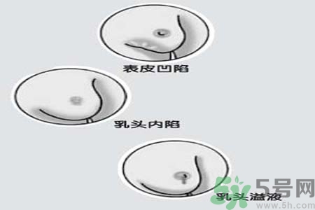 乳頭內(nèi)陷矯正需注意什么？乳頭內(nèi)陷如何預(yù)防？