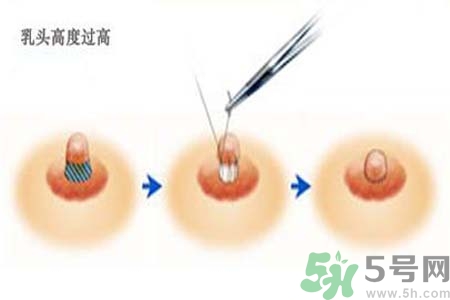 乳頭內(nèi)陷能不能喂奶？乳頭凹陷怎樣哺乳？