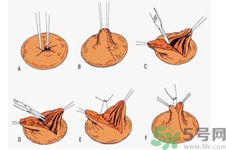 乳頭內(nèi)陷可以拔罐嗎？乳頭內(nèi)陷需要手術(shù)治療嗎？