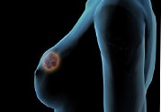 哺乳期乳房有硬塊疼痛怎么辦？如何預(yù)防哺乳期乳房有硬塊？